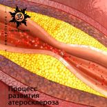 Процесс развития атеросклероза